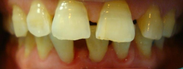 Before — Smile before and after Invisalign treatment
