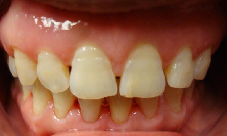 After — Smile before and after Invisalign treatment