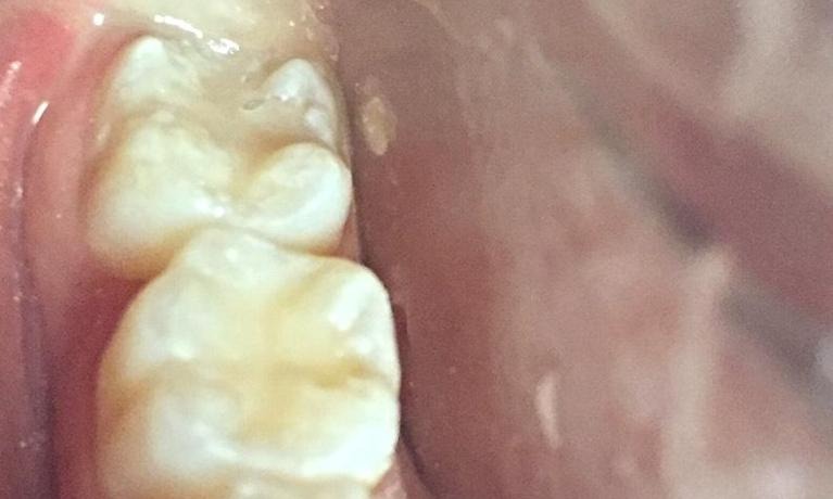 After — Smile with a damaged front tooth before and after a tooth-colored filling