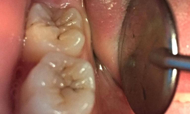 Before — Smile with a damaged front tooth before and after a tooth-colored filling
