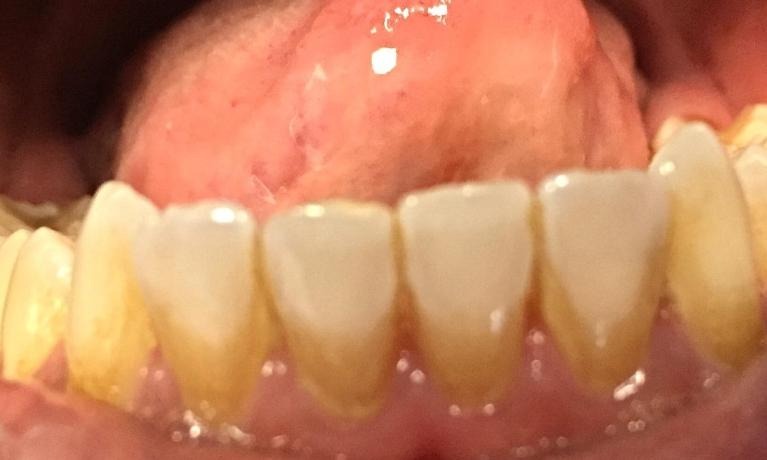 Before — Gums and teeth before and after a deep cleaning at Tooth Doc