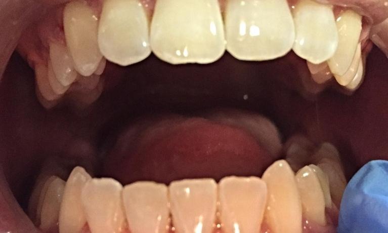 After — Gums and teeth before and after a deep cleaning at Tooth Doc
